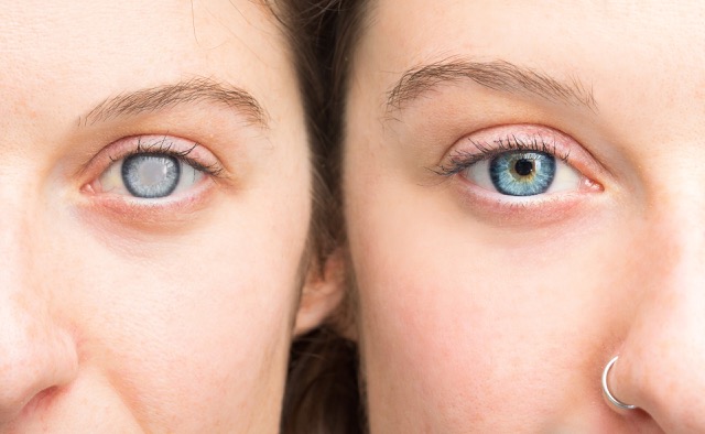 Healthy cataract side by side with a damaged cataract