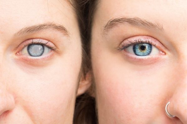 Healthy cataract side by side with a damaged cataract