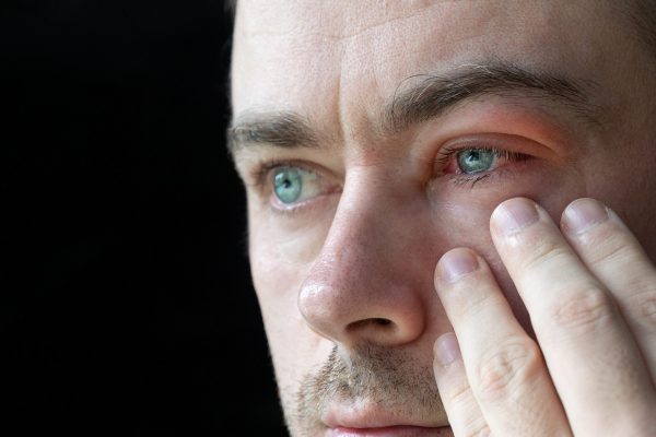 Man with Viral Blepharitis