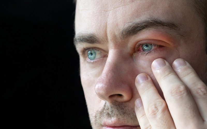 Man with Viral Blepharitis Man with Viral Blepharitis and astigmatism