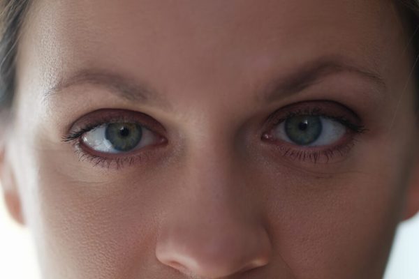 Woman with amblyopia or lazy eye