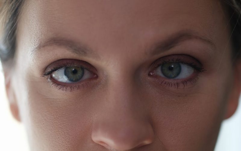 Woman with Amblyopia Woman with amblyopia or lazy eye