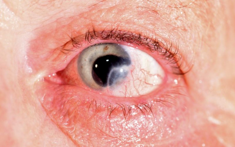 Cornea Scarring