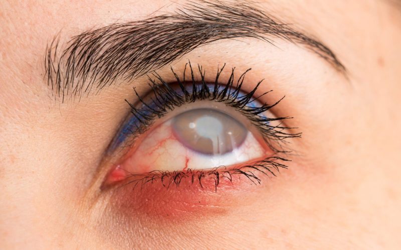 Eye with cataract and opaque cornea Eye with cataract and opaque cornea